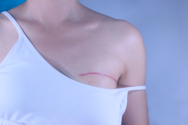 chirurgia cancerului mamar